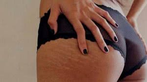 Imagem 4 truques caseiros e fáceis para disfarçar celulites e estrias