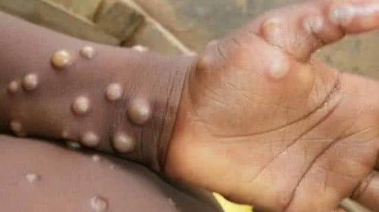 São Paulo monitora primeiro caso suspeito | Foto: OMS