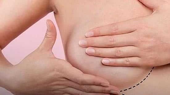 Foto: Divulgação/Sociedade Brasileira de Mastologia