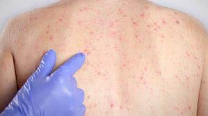 Imagem Sarampo avança no Brasil, e medo de coronavírus dificulta vacinação