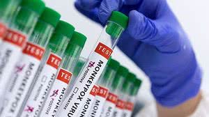 Doença foi detectada em um homem de 29 anos | Foto: Reprodução/Dado Ruvic