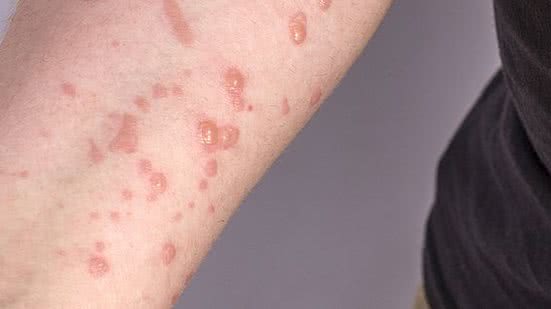 Imagem Cai para 33 número de casos suspeitos de varíola dos macacos em Alagoas