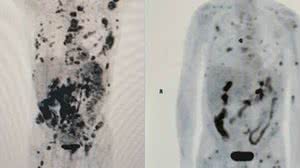 Imagem mostra regressão de câncer em paciente após tratamento inédito | Reprodução