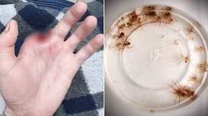 Homem teve o dedo amputado após ser picado por uma aranha-marrom | Arquivo Pessoal | Alex Ferreira / TV Tribuna