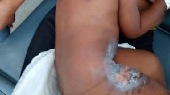 Menino sofreu queimaduras em diversas partes do corpo | Foto: Reprodução