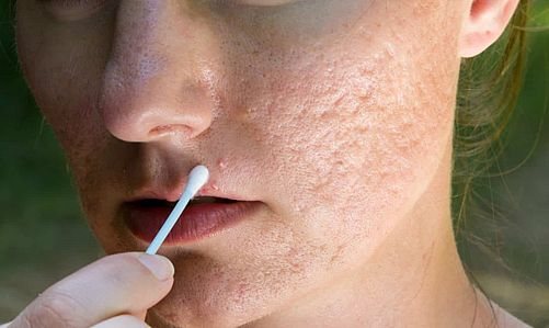 Imagem Acabe com a acne: dicas infalíveis para uma pele saudável