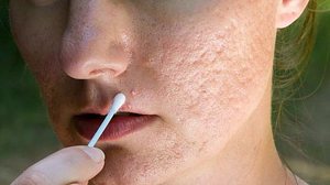 Imagem Acabe com a acne: dicas infalíveis para uma pele saudável