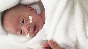 Ao nascer, o bebê era tão pequeno que cabia na palma da mão de um adulto. | Keio University Hospital/Divulgação