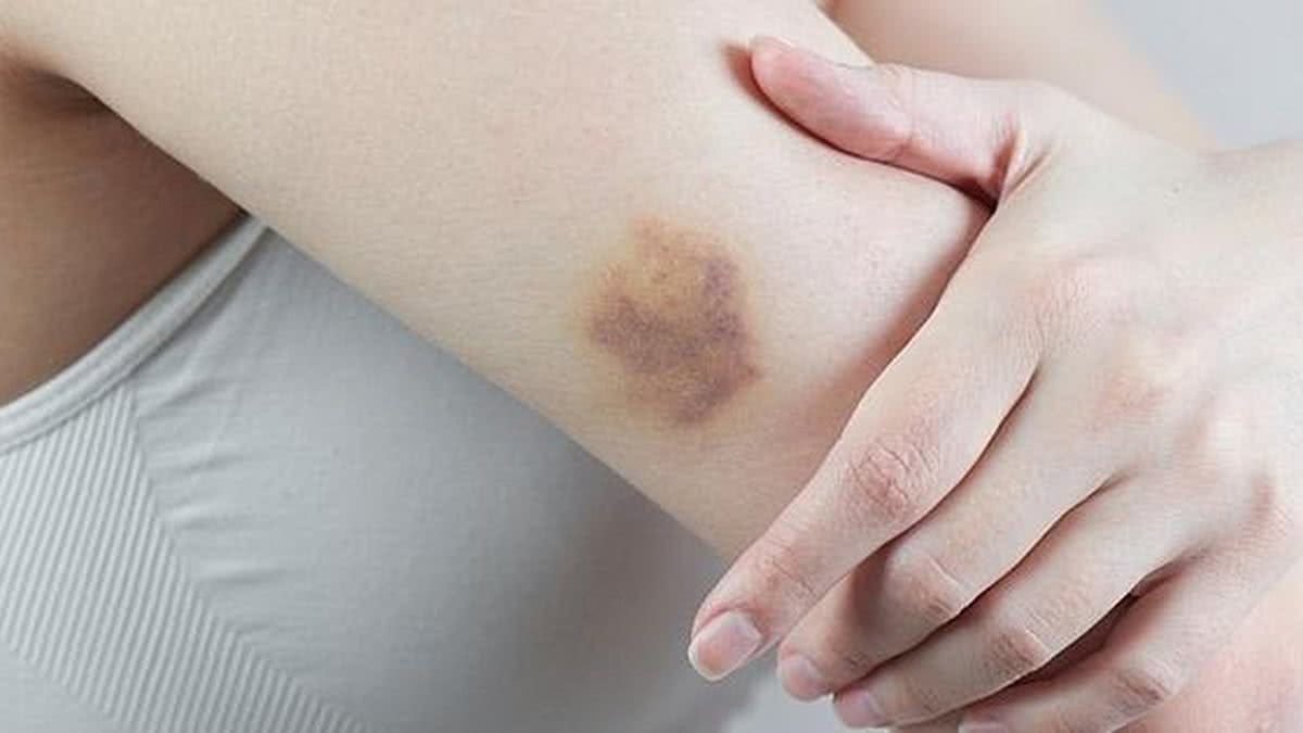 Machucou? Conheça seis dicas simples para tirar o roxo da pele