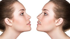 Utilização de um ácido em rinoplastias pode melhorar resultados da cirurgia | Ilustração