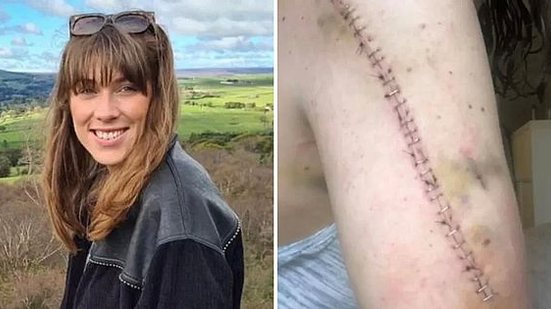 Royle foi submetida a tratamentos e cirurgia para retirada do melanoma que nunca existiu | Reprodução / Redes sociais