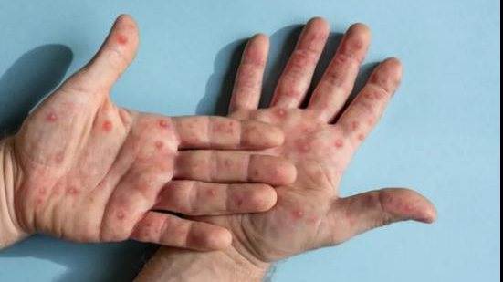 Imagem Mpox não é nova covid, diz diretor da OMS na Europa