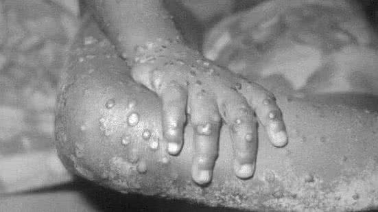 Foto: Reprodução/CDC