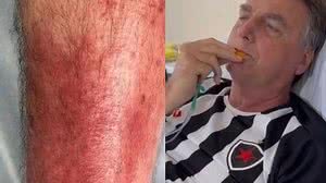Imagem Saiba o que é erisipela, doença de pele que afeta o ex-presidente Jair Bolsonaro