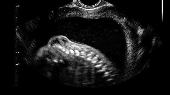 Imagem de ultrassom mostra, à esquerda, a malformação; o procedimento pelo qual passaram Karem e Enzo pode ser uma alternativa à cirurgia a céu aberto | Karime Xavier/Folhapress