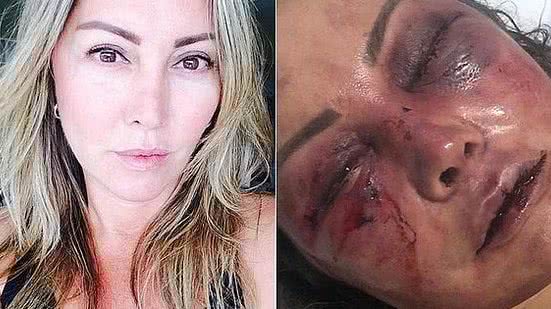 Elaine teve pontos de fratura pelo rosto e vai precisar passar por cirurgia plástica | Reprodução