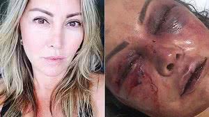 Elaine teve pontos de fratura pelo rosto e vai precisar passar por cirurgia plástica | Reprodução