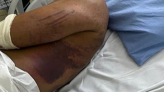 Hematomas no corpo de major da PM | Reprodução/MPGO