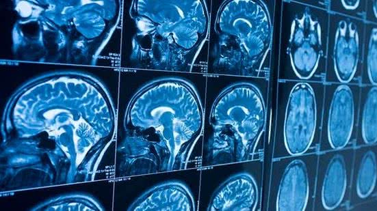 Covid-19 pode causar encolhimento do cérebro e perda de memória, mostra estudo de Oxford | Foto: iSotck