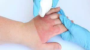 Uso errado do álcool para prevenir Covid-19 pode provocar queimaduras | Divulgação