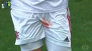 Imagem Trauma no testículo, como de jogador do Flamengo, pode afetar fertilidade; entenda