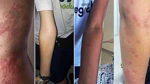 Moradores mostram marcas na pele que causam coceira e ardencia. | Reprodução Correio24horas