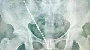 A corrente de bolinhas de metal foi inserida na uretra | Foto: Divulgação/Universidade Médica de Taipé