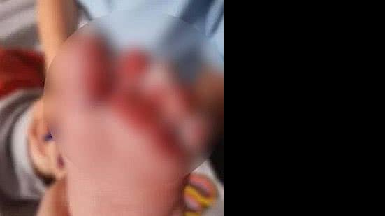 Imagem Bebê sofre queimaduras durante banho em creche de SC
