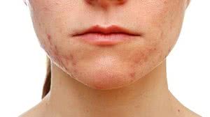 A acne, vulgarmente conhecida como espinhas e cravos, aparece em decorrência de processos inflamatórios das glândulas sebáceas e folículos pilossebáceos | iStock/Getty Images