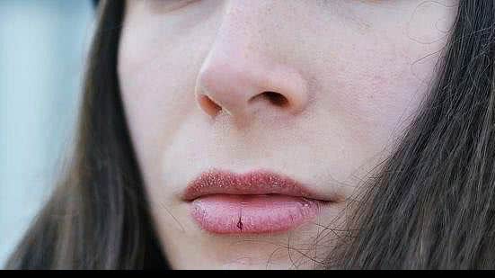 Clima seco do inverno pode causar rachaduras nos lábios | Foto: Reprodução/Pixabay