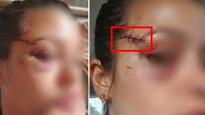 Policial teve ferimento no rosto e chegou a perder a sensibilidade na região na época | Reprodução