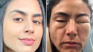 Amanda Nicândio, de 22 anos, compartilhou recentemente relato sobre reação alérgica ocorrida em 2021 | Foto: Reprodução/Arquivo Pessoal