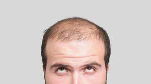 Motivos da queda precoce de cabelo podem variar | Reprodução/Google