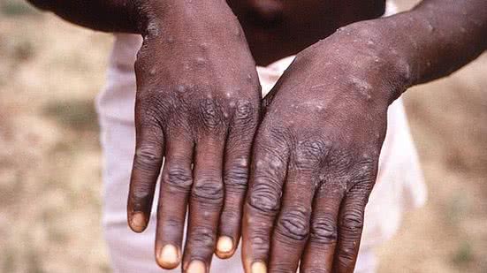 Já foram confirmados mais de 120 casos em 16 países | Foto: Reprodução