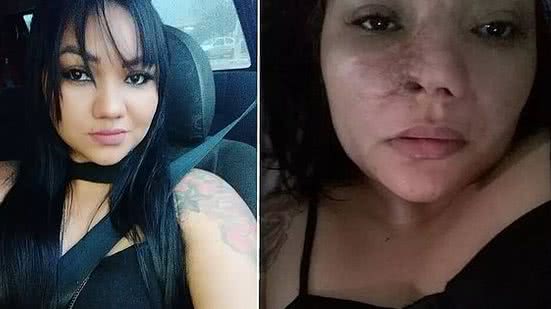 Paciente já passou por 14 cirurgias após ter a infecção e necrose | Foto: Reprodução/Arquivo Pessoal