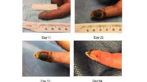 Acima, imagens da ferida da paciente nos dias e meses após o acidente. A cicatrização ocorreu apenas quatro meses depois | Reprodução/CDC