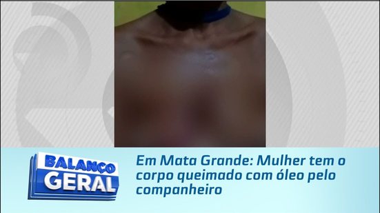 Em Mata Grande: Mulher tem o corpo queimado com óleo pelo companheiro