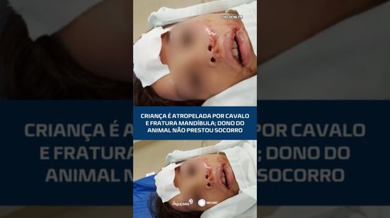 Criança é atropelada por cavalo e fratura mandíbula; dono do animal não prestou socorro #CidadeAL