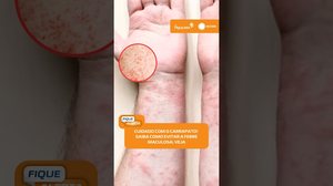 ⚠️ Febre maculosa: saiba como ocorre a transmissão e como se proteger #FiqueAlerta