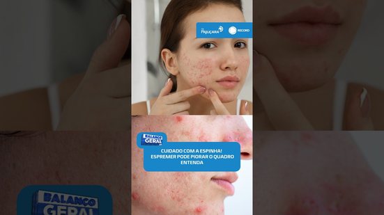 ⚠️ Espremer espinhas pode piorar a inflamação e deixar manchas e cicatrizes #BalançoGeralAL