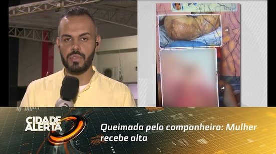 Queimada pelo companheiro: Mulher recebe alta