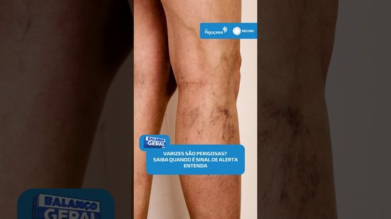 🩺 Varizes: veja os sinais que indicam que é hora de procurar um médico | #BalançoGeralAL