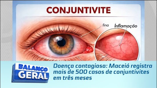 Doença contagiosa: Maceió registra mais de 500 casos de conjuntivites em três meses