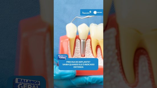 🦷Implante dentário: entenda como funciona e para quem é indicado #BalançoGeralAL