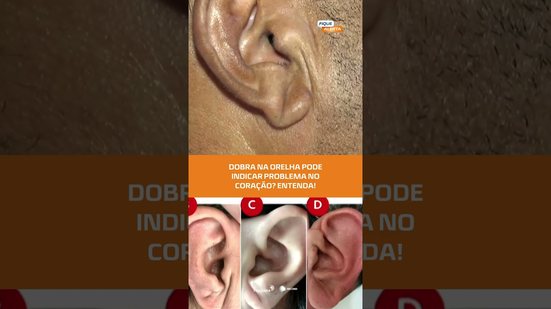 Sinal de Frank: dobra na orelha pode indicar risco cardíaco, entenda! #FiqueAlerta