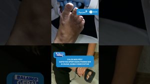 ⚠️Calos nos pés? Veja como prevenir calos e cuidar melhor dos pés #BalançoGeralAL