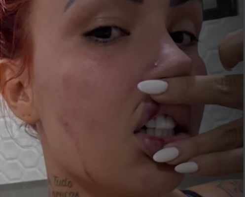 Ruivão exibiu marcas de agressões na rede social. Foto: Reprodução