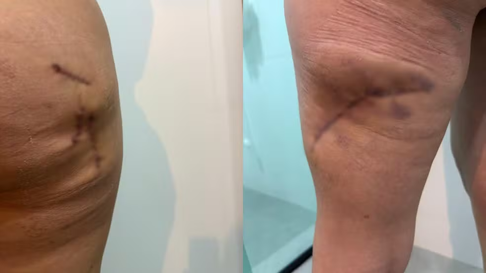 Lesões com pontos no glúteo direito (imagem à esquerda) e atrás da perna esquerda — Foto: Karim Kamada/Arquivo pessoal