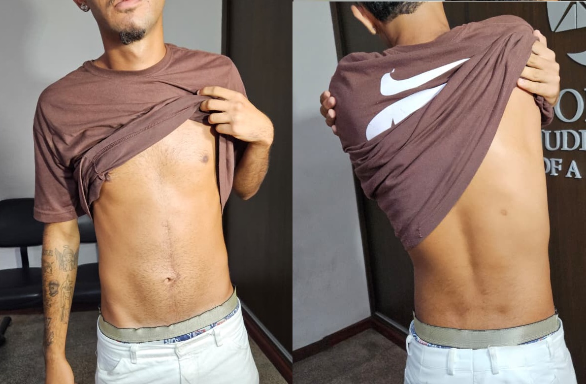 Gustavo exibiu marca de bala alojada resultado da tentativa de homicídio praticada por Albino dos Santos. Foto: João Arthur Sampaio/TNH1