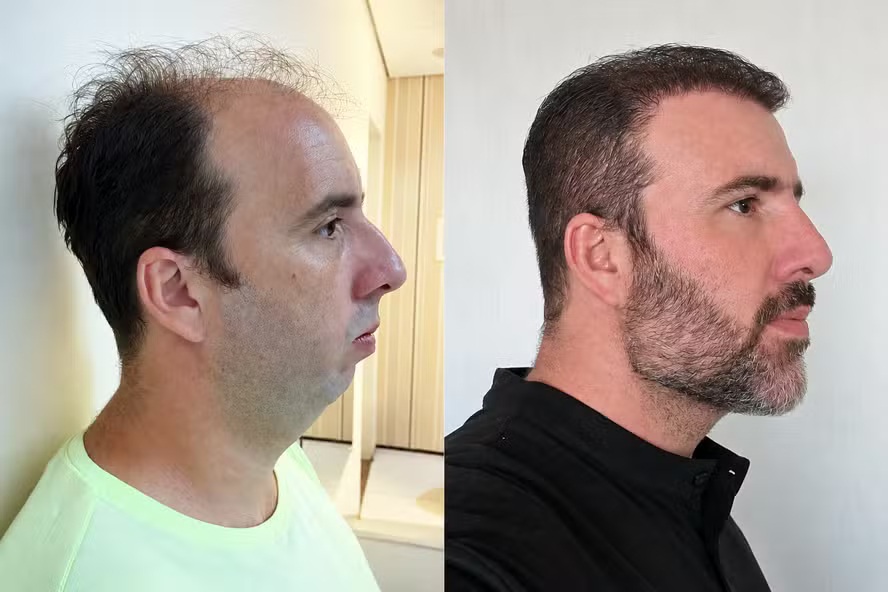 Homem viraliza após harmonização facial; antes e depois surpreende